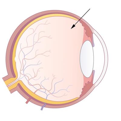 Schematische Darstellung der IVOM-Therapie