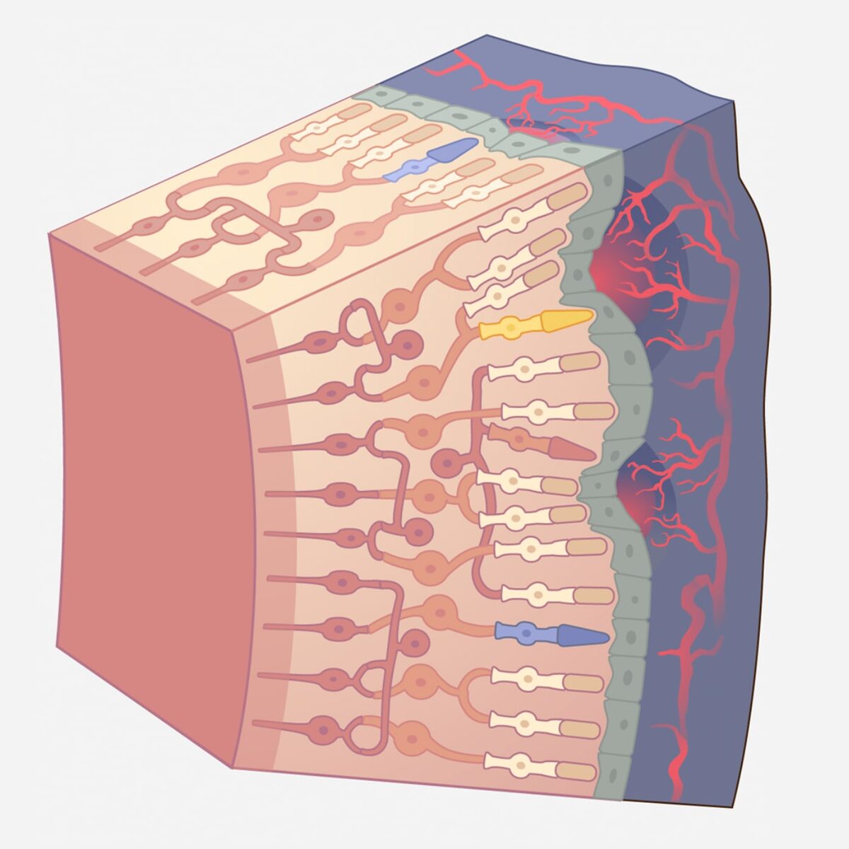 Illustration der Makula mit Darstellung eines unkontrollierten Gefäßwachstums.