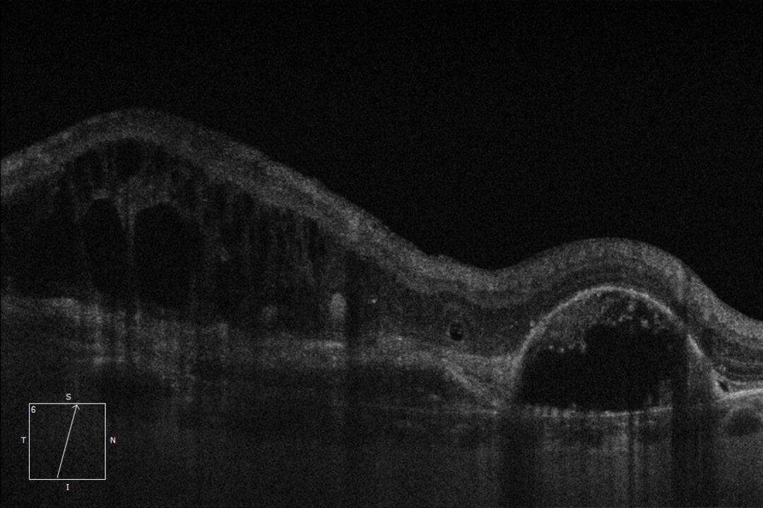 OCT-Scan des Auges mit feuchter unbehandelter AMD.