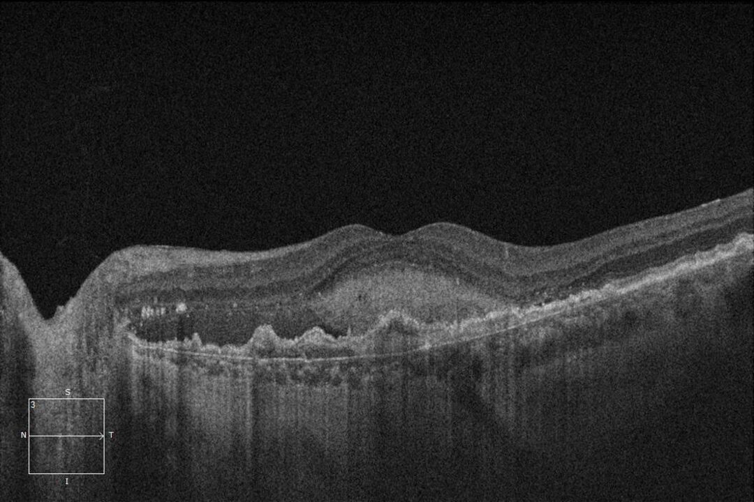 OCT-Scan eines Auges mit unbehandelter feuchter AMD.