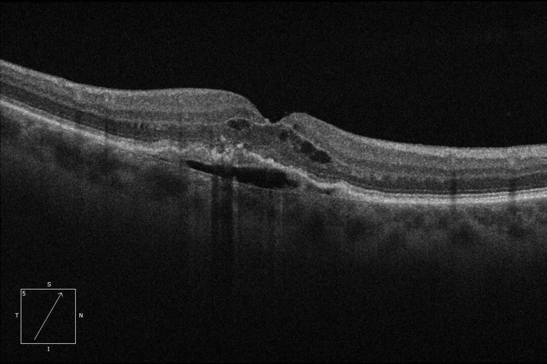Feuchte Makuladegeneration mit intraretinaler Flüssigkeit.