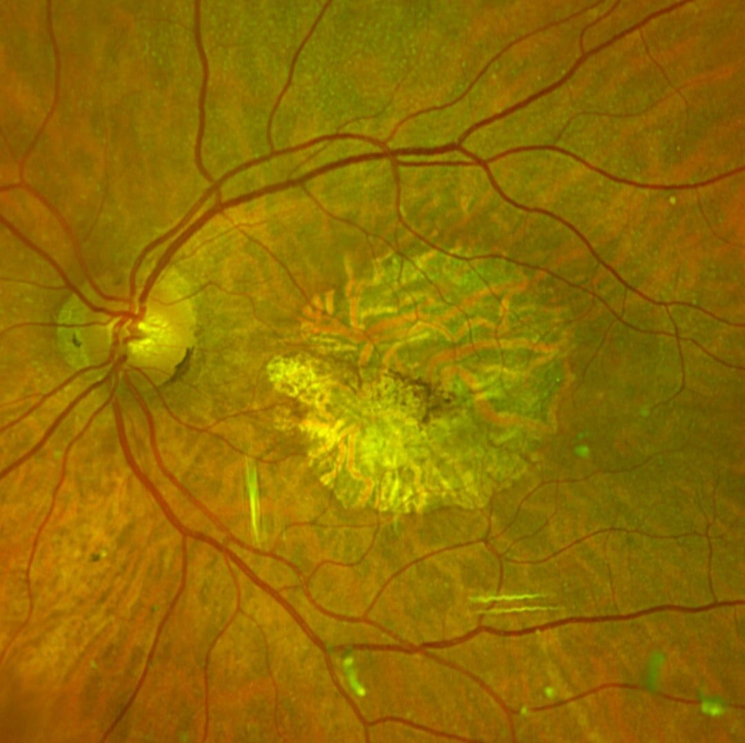 Die geographische Atrophie (GA) eine Spätfolge der trockenen AMD