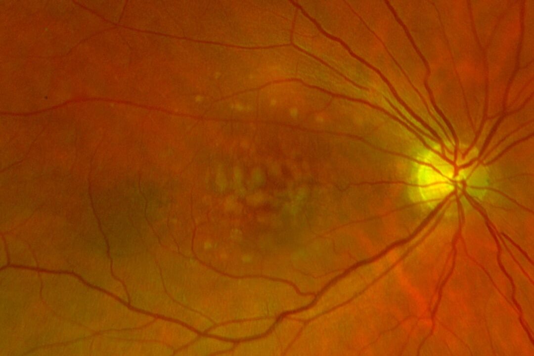 Progression der AMD innerhalb von drei Jahren.