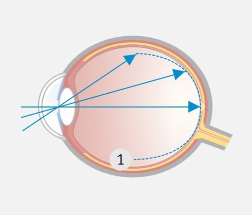 Kann das SMILE Augenlasern die Progression von Kurzsichtigkeit hemmen?