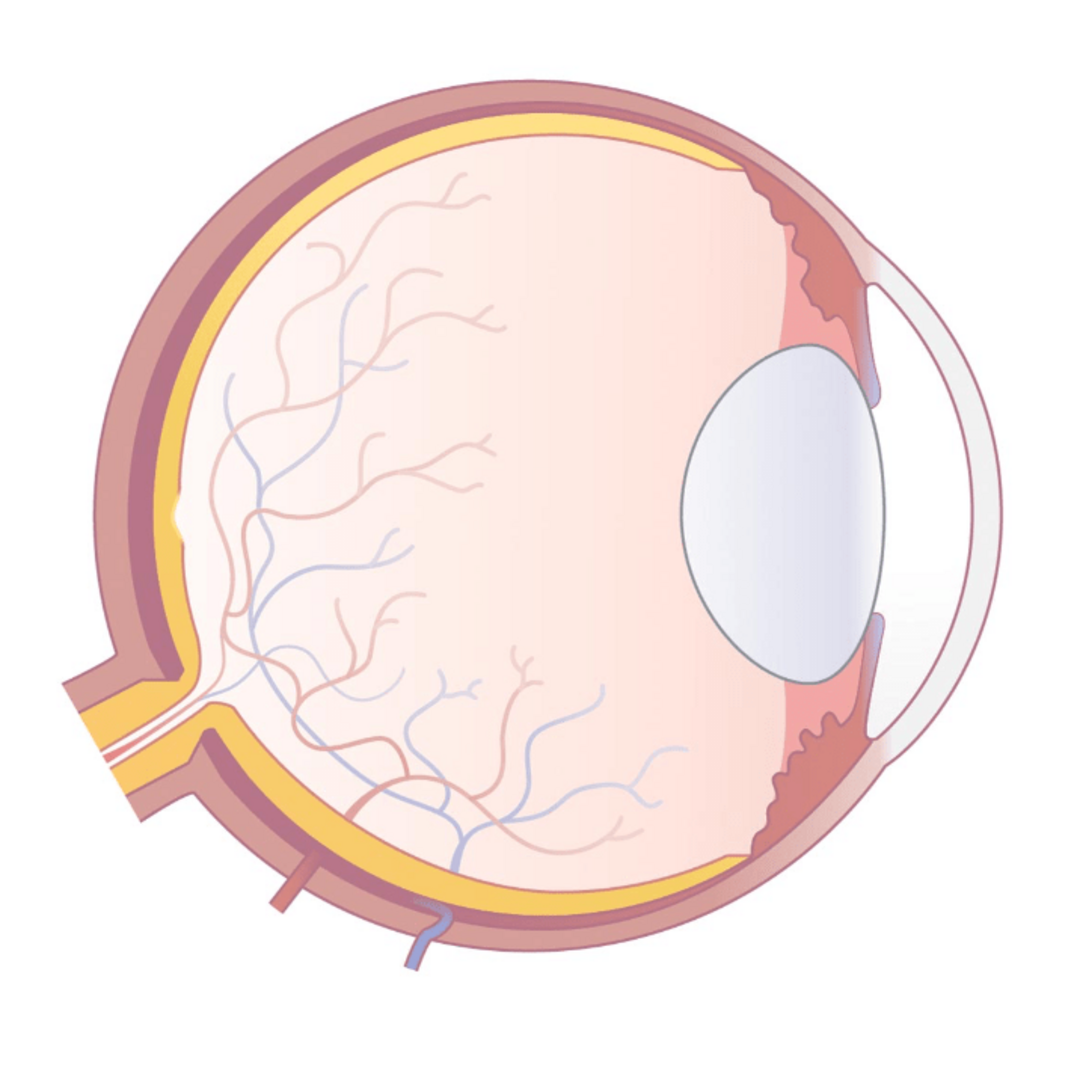 Augenillustration mit getrübter und vergrößerter Augenlinse.