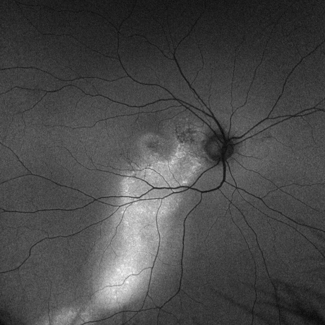Fundusautofluoreszenz bei chronischer CCS.
