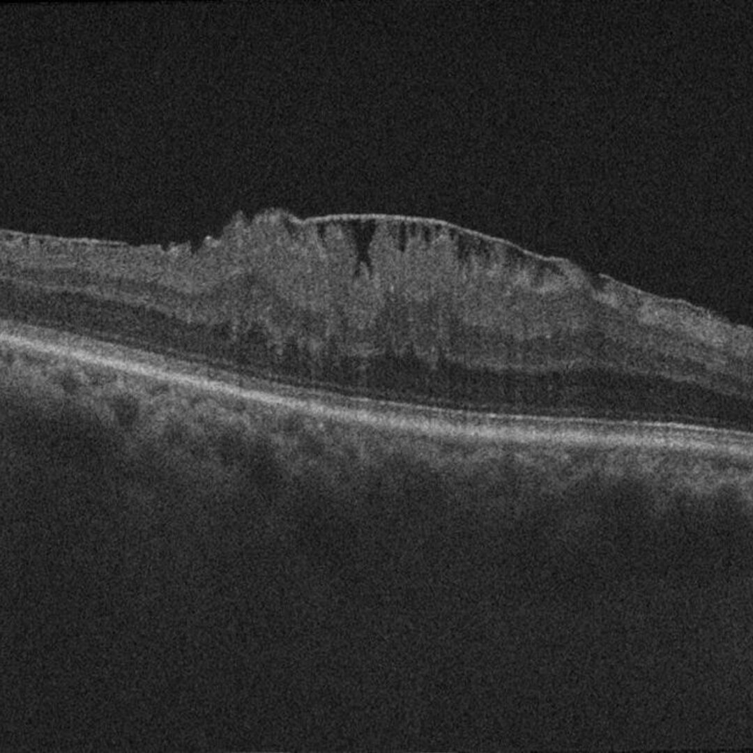 OCT einer epiretinalen Gliose (Macular Pucker).