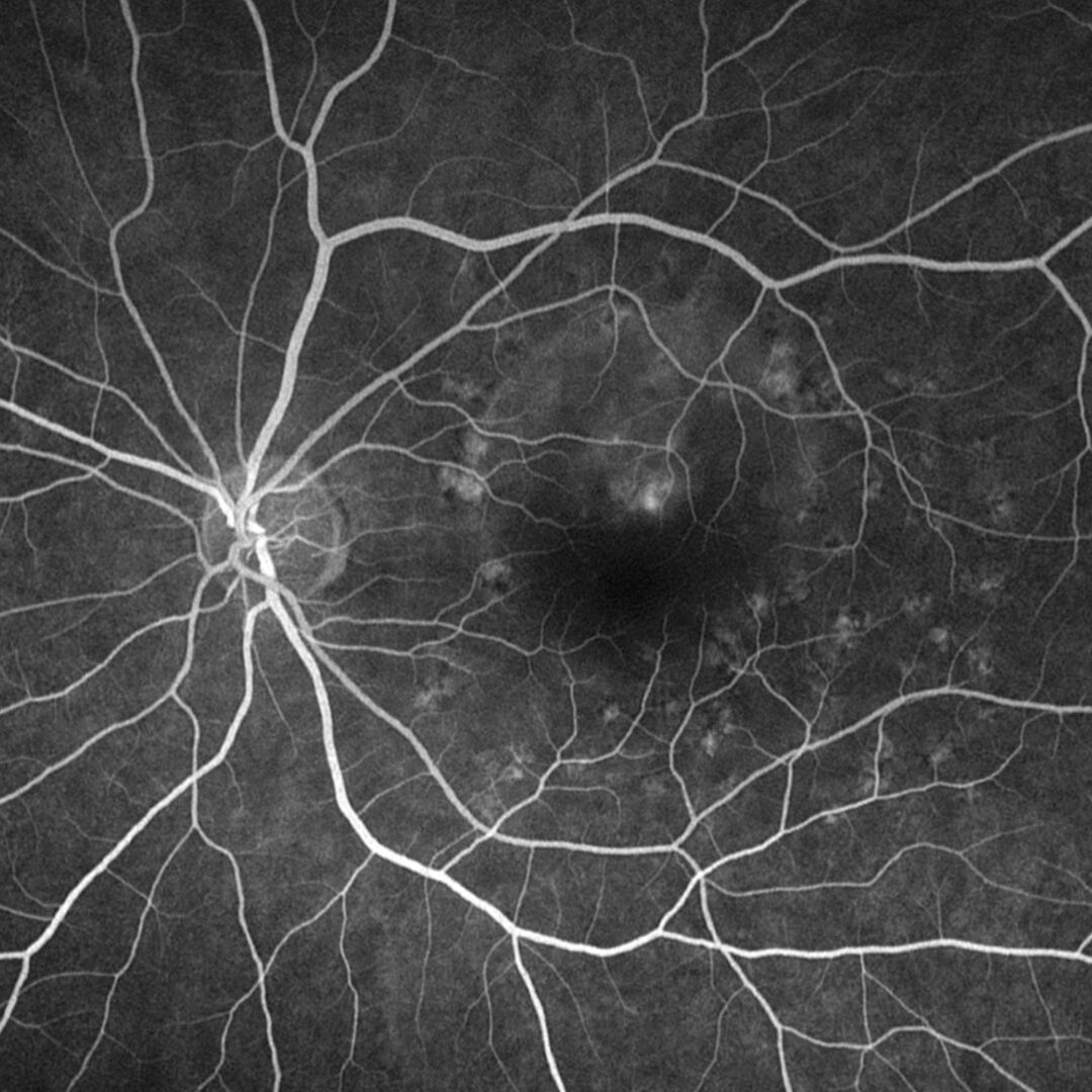 Fluoreszenzangiographie einer blasenähnlichen Abhebung unterhalb der Makula bei CCS.