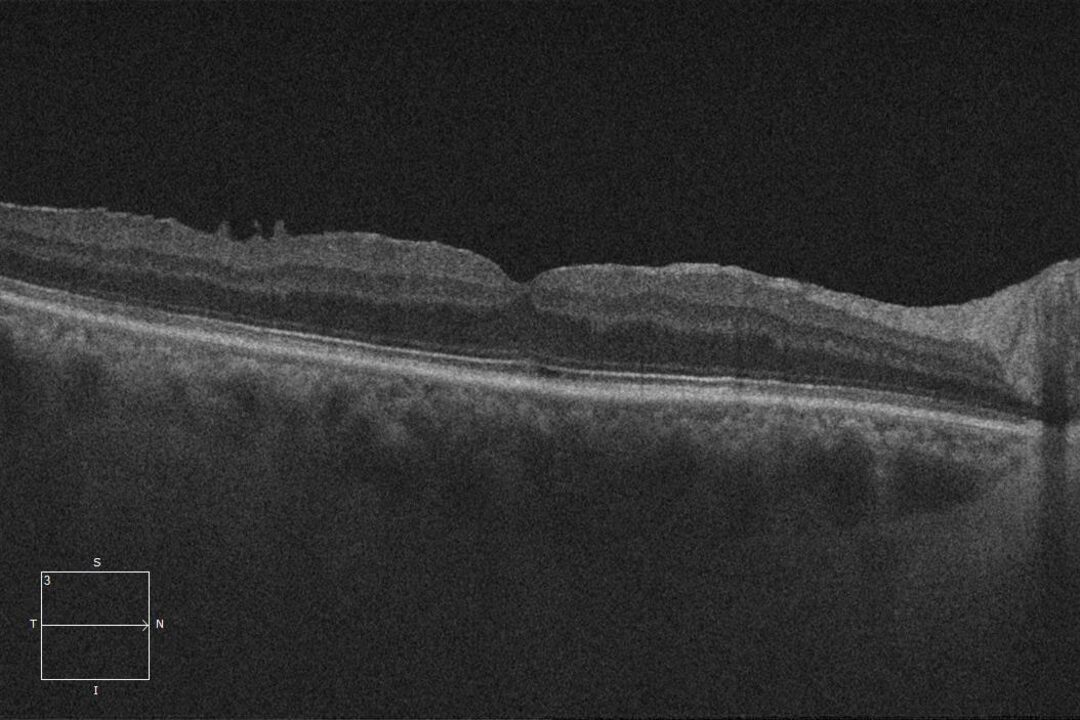 Nach dem Begrenzungsmembran-Peeling (ILM) bei Epiretinaler Gliose.