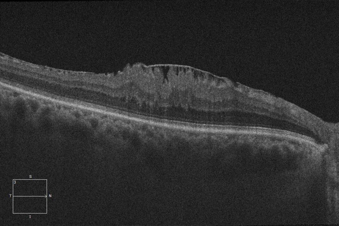 3. Epiretinale Gliose mit sichtbarer Membran.