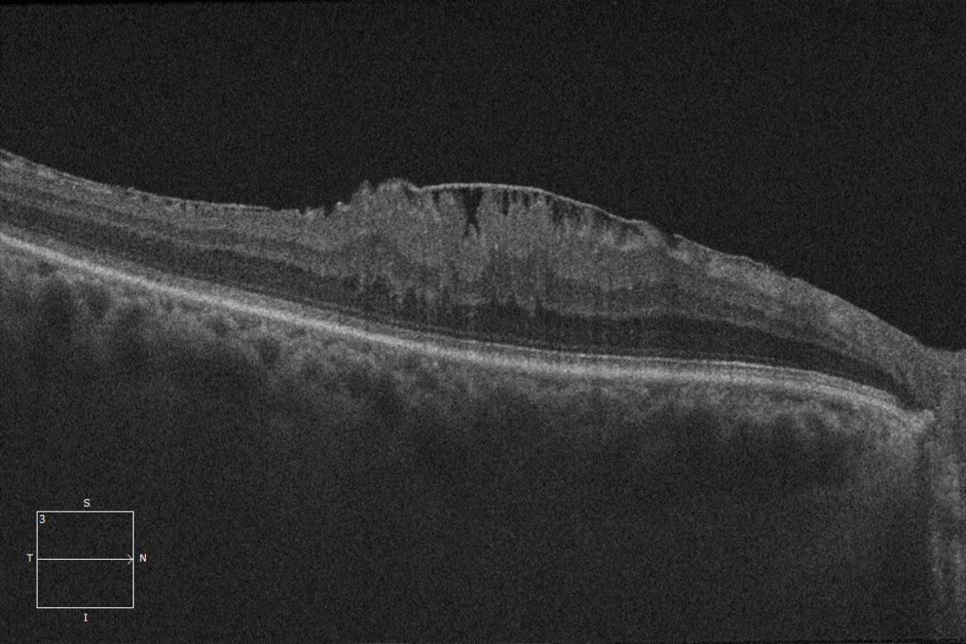 3. Epiretinale Gliose mit sichtbarer Membran.