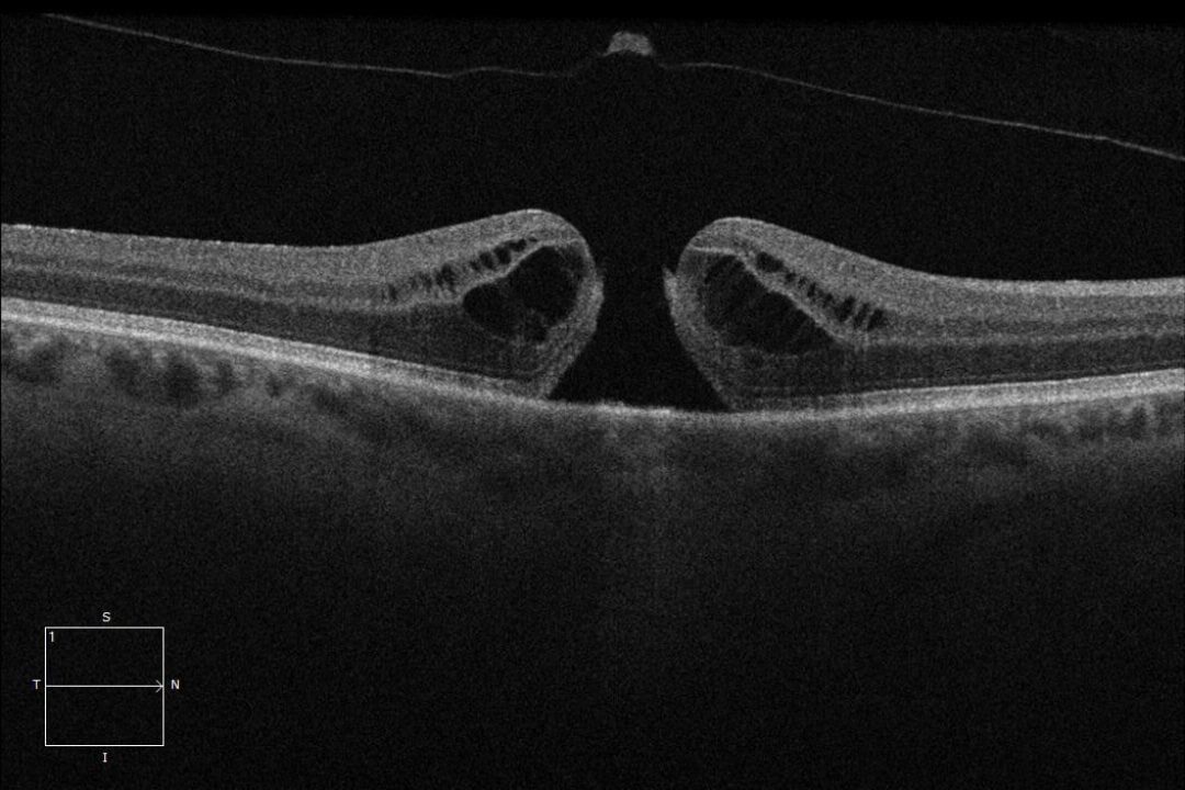 Durchgreifendes Makulaloch (Makulaforamen), über dem die zarte Glaskörpermembran sichtbar ist.