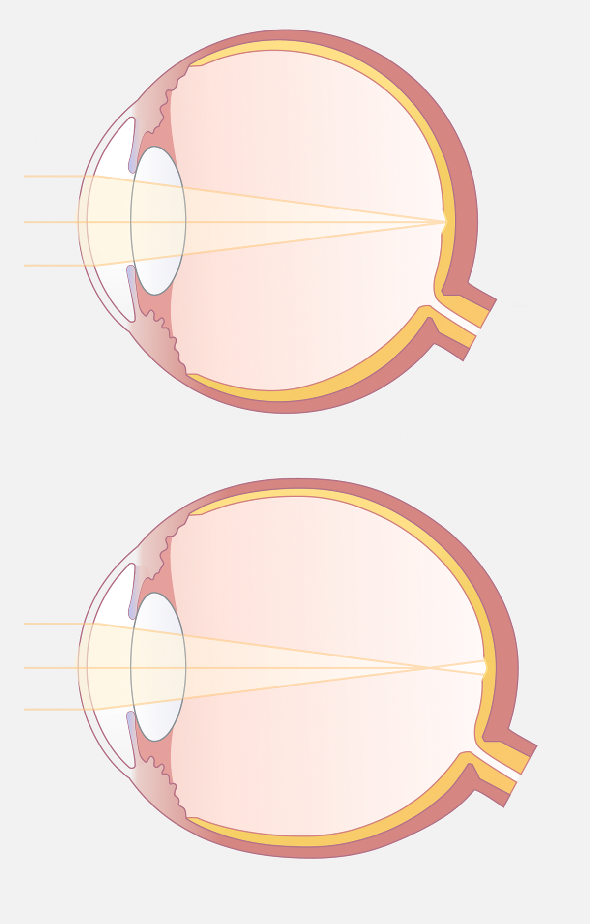Der Lichteinfall bei einem kurzsichtigen Auge.