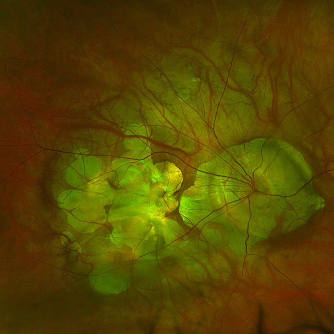 Myopischer Fundus mit Dehnungsherden.