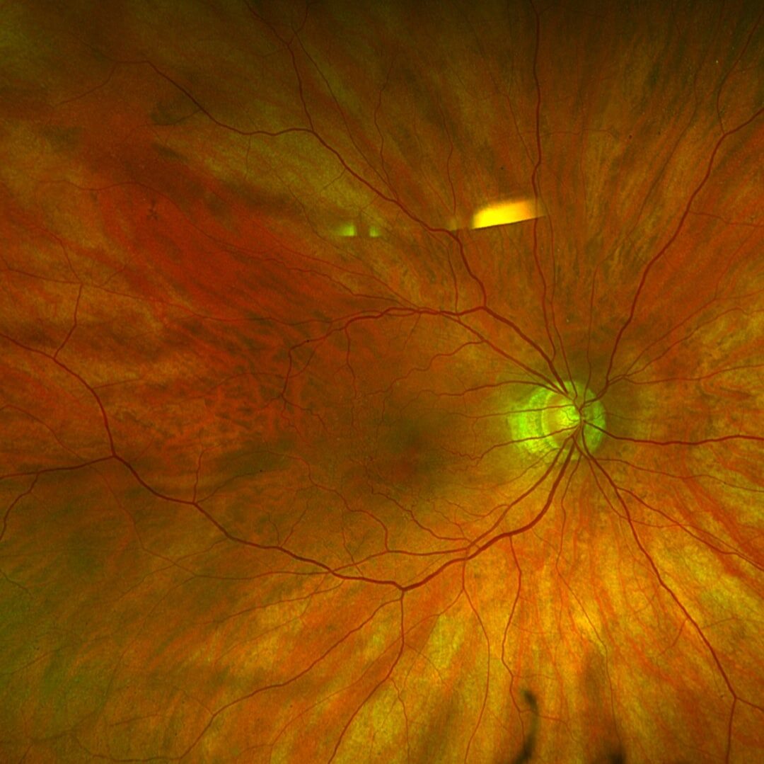 Myopischer Fundus