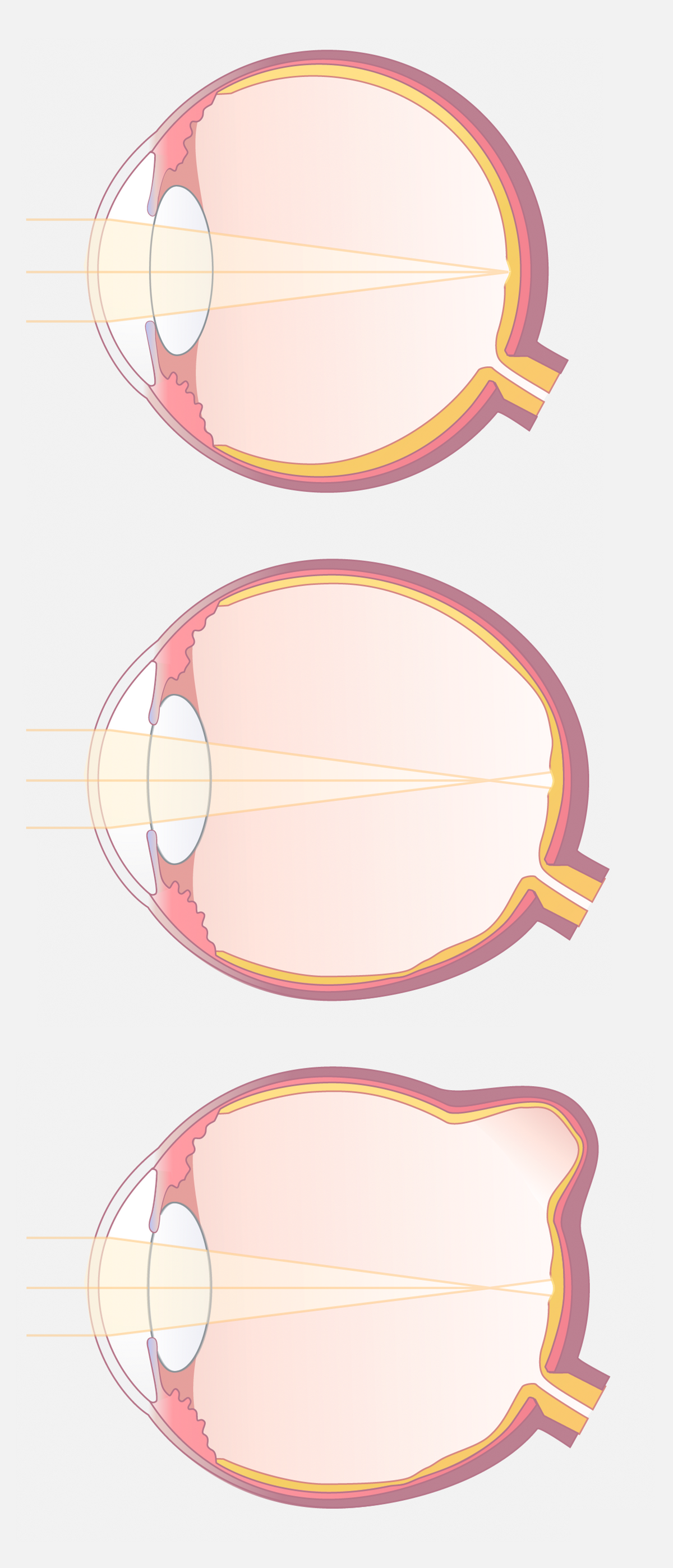 v.l.n.r.: Normalsichtiges Auge, verlängertes kurzsichtiges Auge und Auge mit pathologischer Myopie mit Aussackung am hinteren Augenpol (Staphylom)