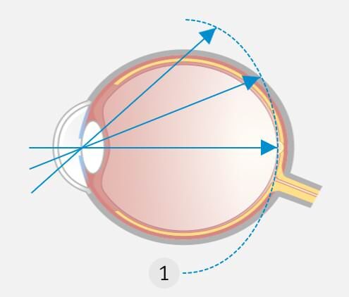 Korrektur der Kurzsichtigkeit mit Einstärken-Brille: Einstärkegläser korrigieren Kurzsichtigkeit so, dass die Schärfenebene (1) genau auf die Netzhautmitte fällt, in der gesamten Peripherie jedoch dahinter (hyperoper Defokus) liegt.