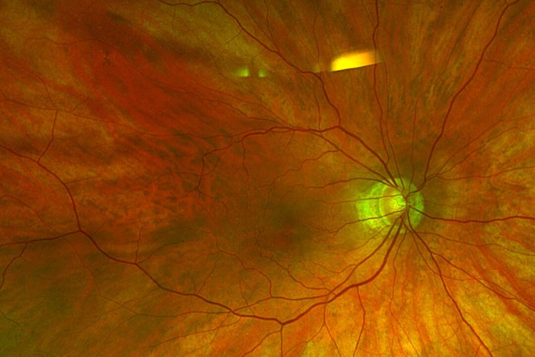 Myoper Fundus mit verdünnten und leicht transparenten Strukturen.