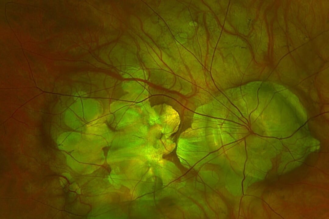 Myoper Fundus mit sichtbaren Dehnungsherden.