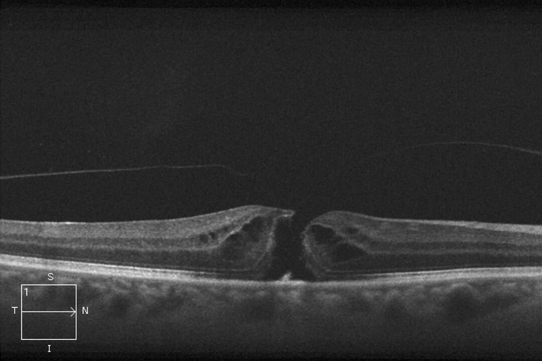 Makulaforamen vor der Operation