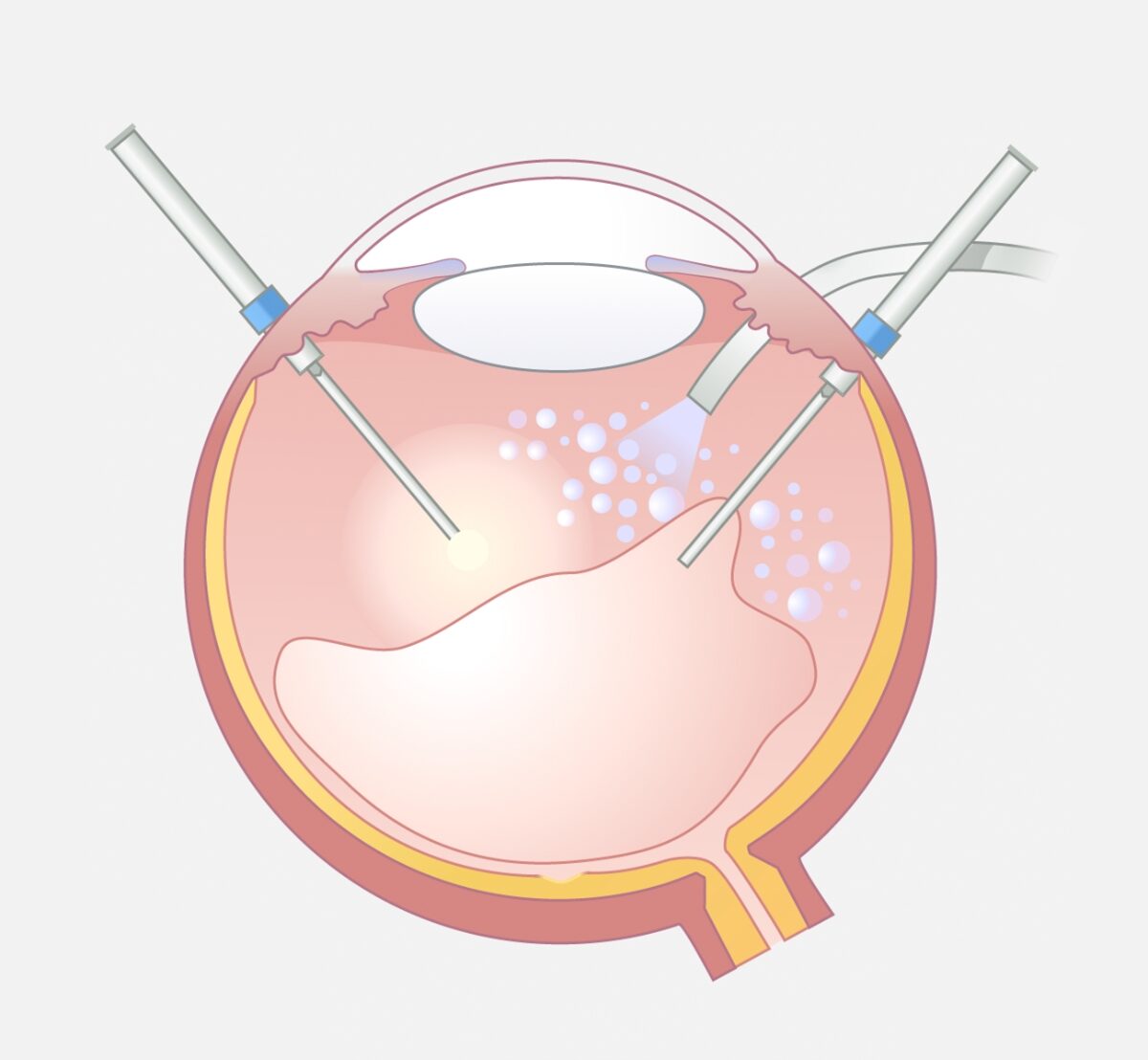 Illustration einer Vitrektomie.