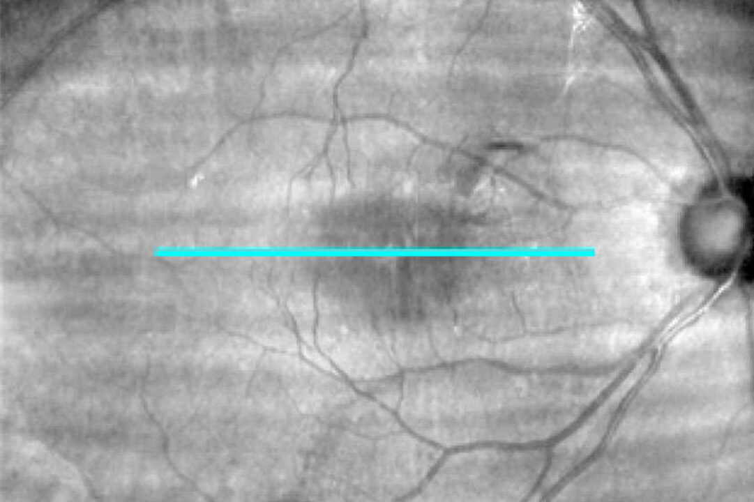 Makulaforamen vor der Operation