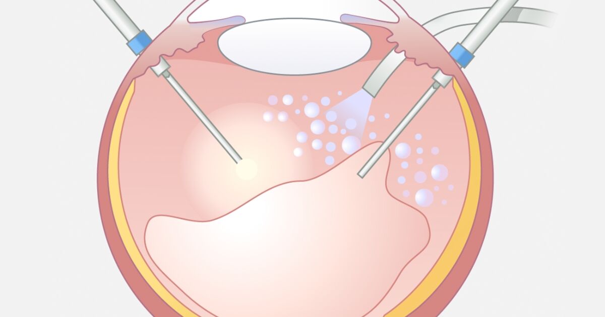 Die Glaskörperoperation, Vitrektomie oder ParsplanaVitrektomie (PPV