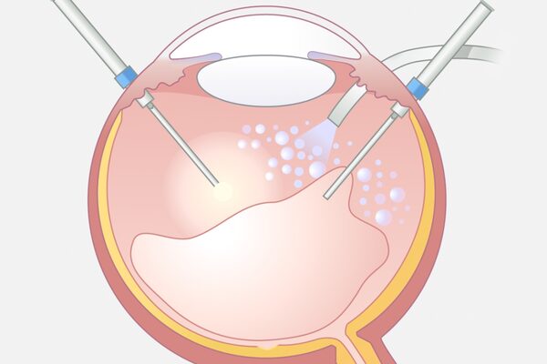 Illustration einer 27Gauge Vitrektomie