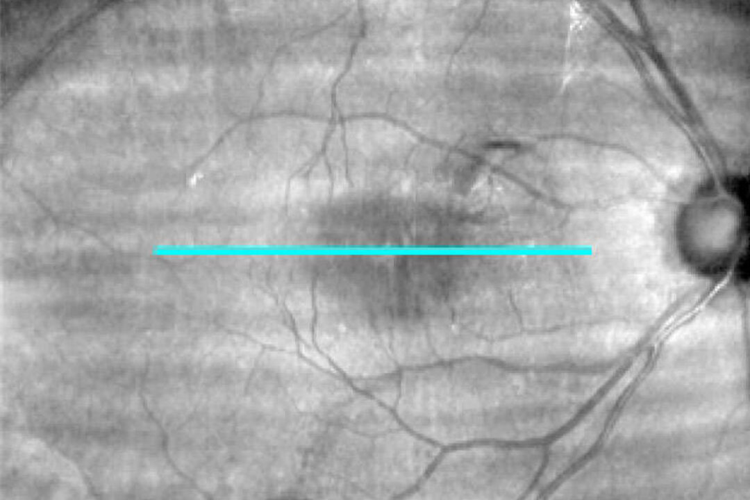 Makulaforamen vor der Operation