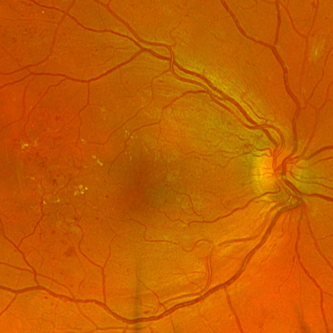 Diabetische Retinopathie