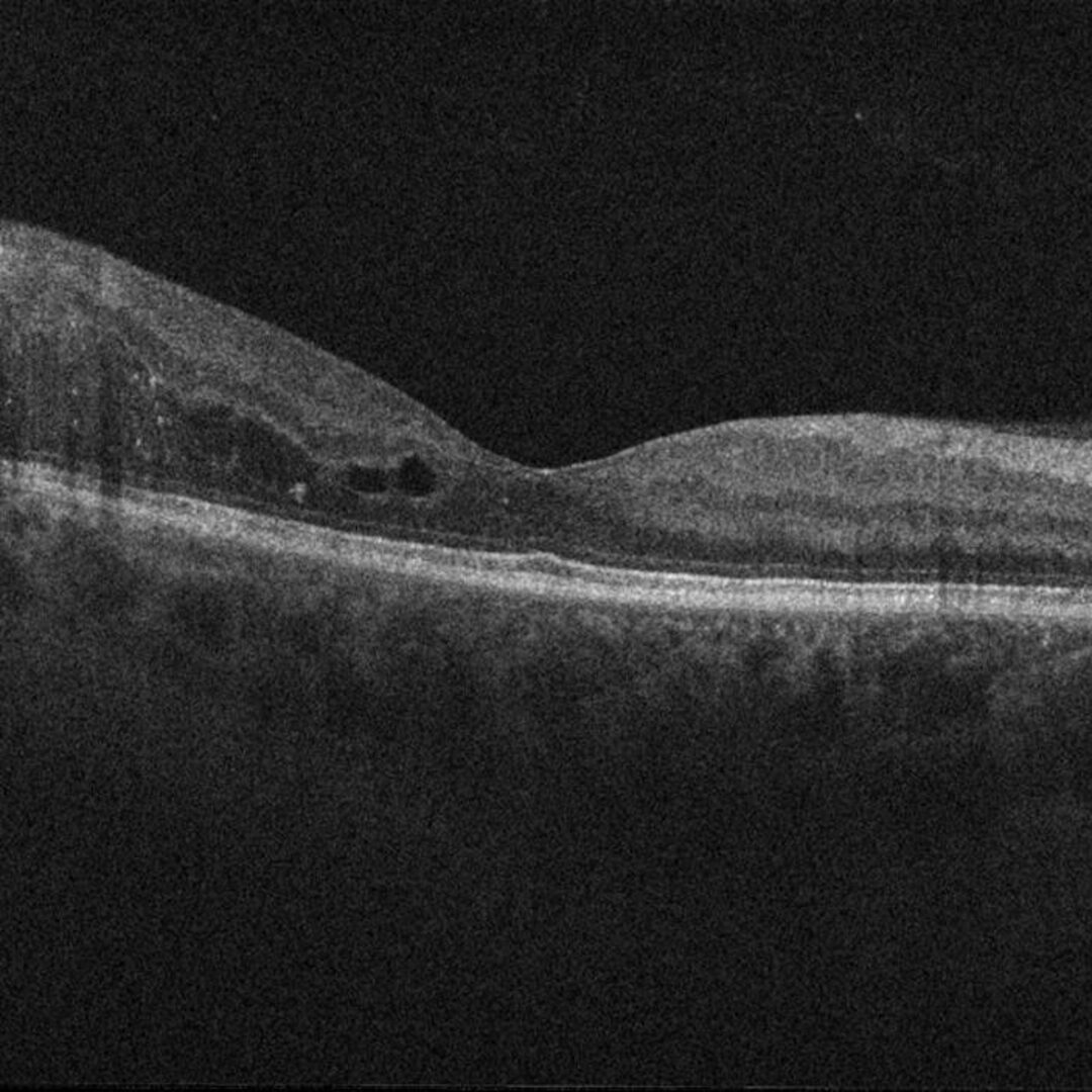 Diabetische Retinopathie