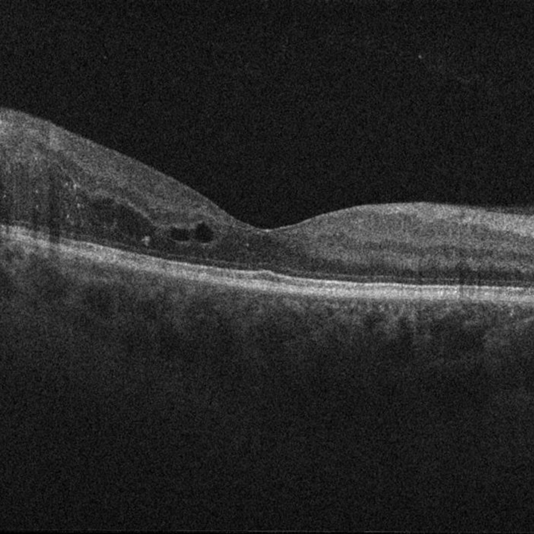Diabetische Retinopathie
