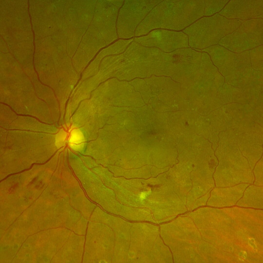 Diabetische Retinopathie