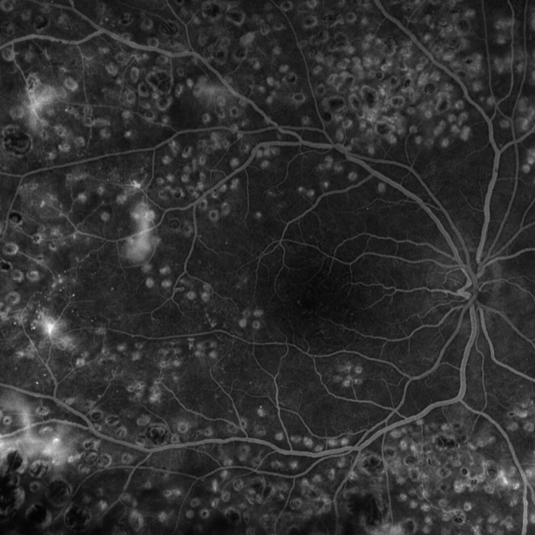 Diabetische Retinopathie mit Gefäßneubildungen in der Peripherie.