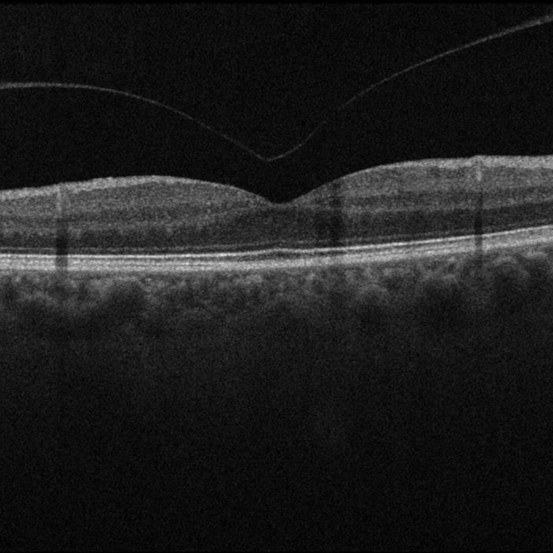 OCT-Scan mit hinterer Glaskörperabhebung.