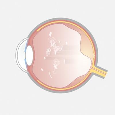 Diffuse Floater.