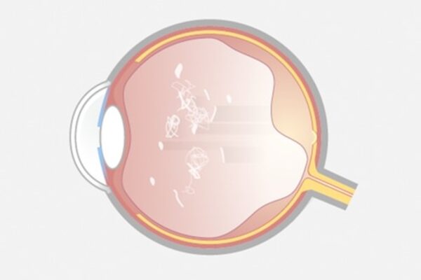 Diffuse Floater.