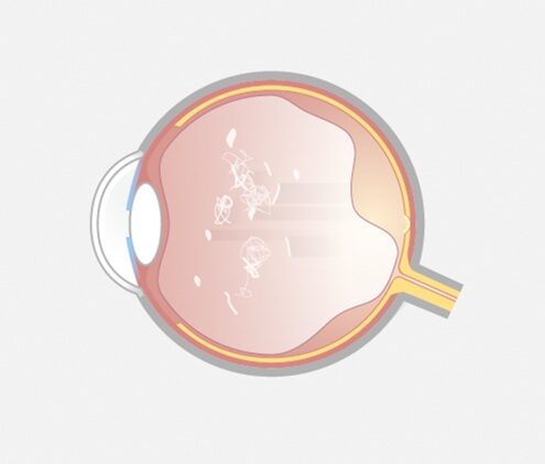 Laser-Vitreolyse