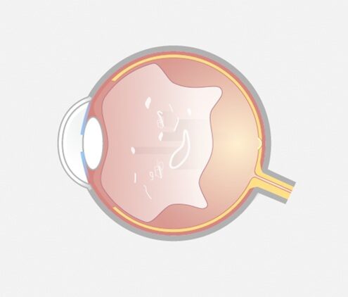Laser-Vitreolyse