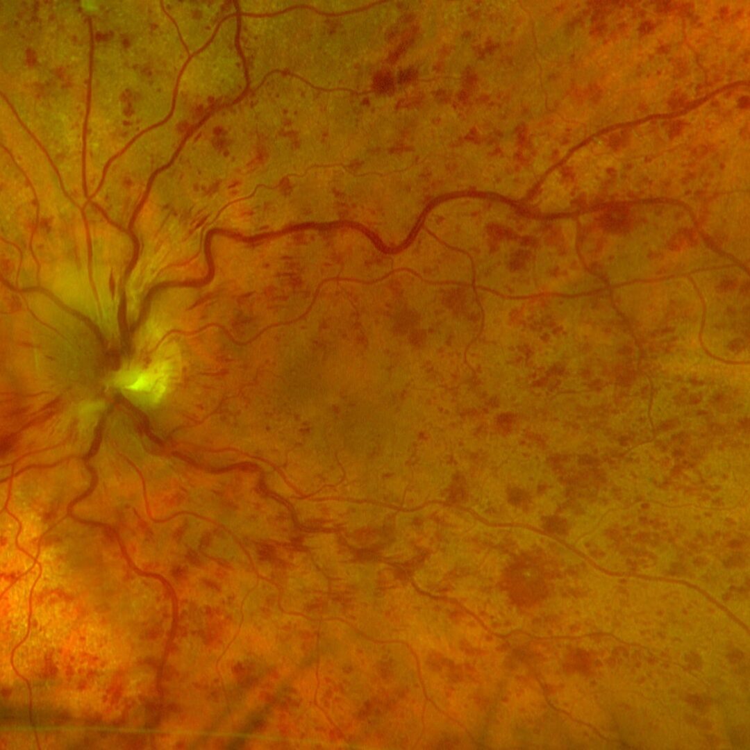 Fundusbild der Netzhaut am linken Auge in der Akutphase eines Zentralvenenverschlusses.