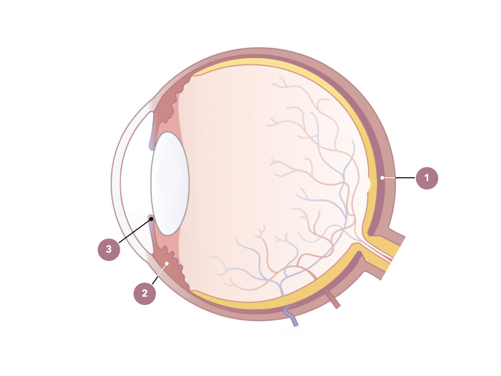 Uveitis – Augenentzündungen