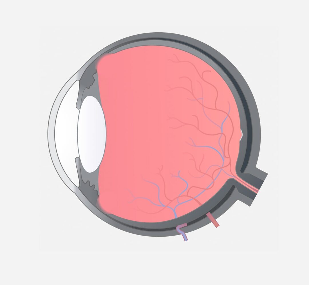 Uveitis intermedia