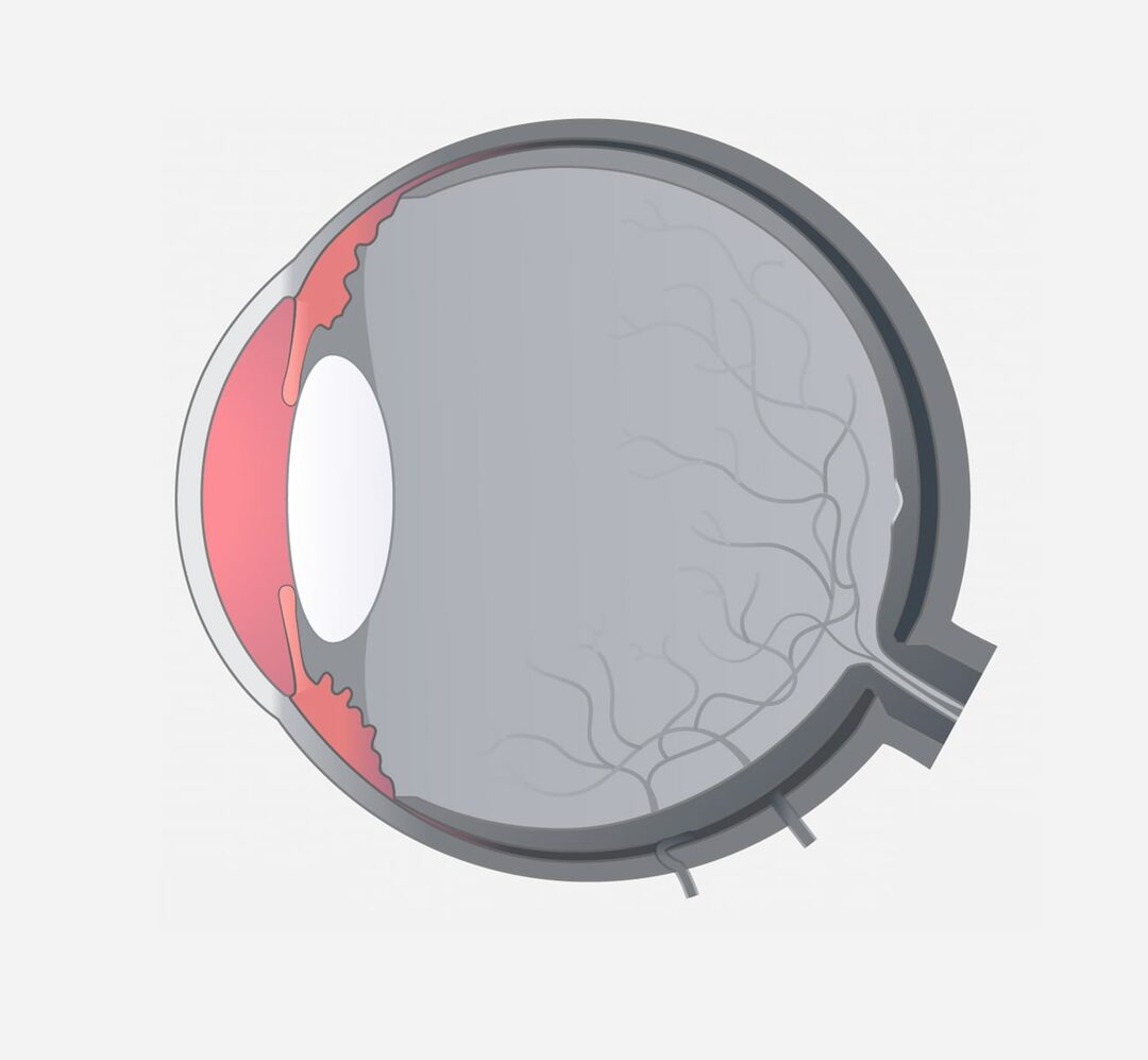 Uveitis anterior