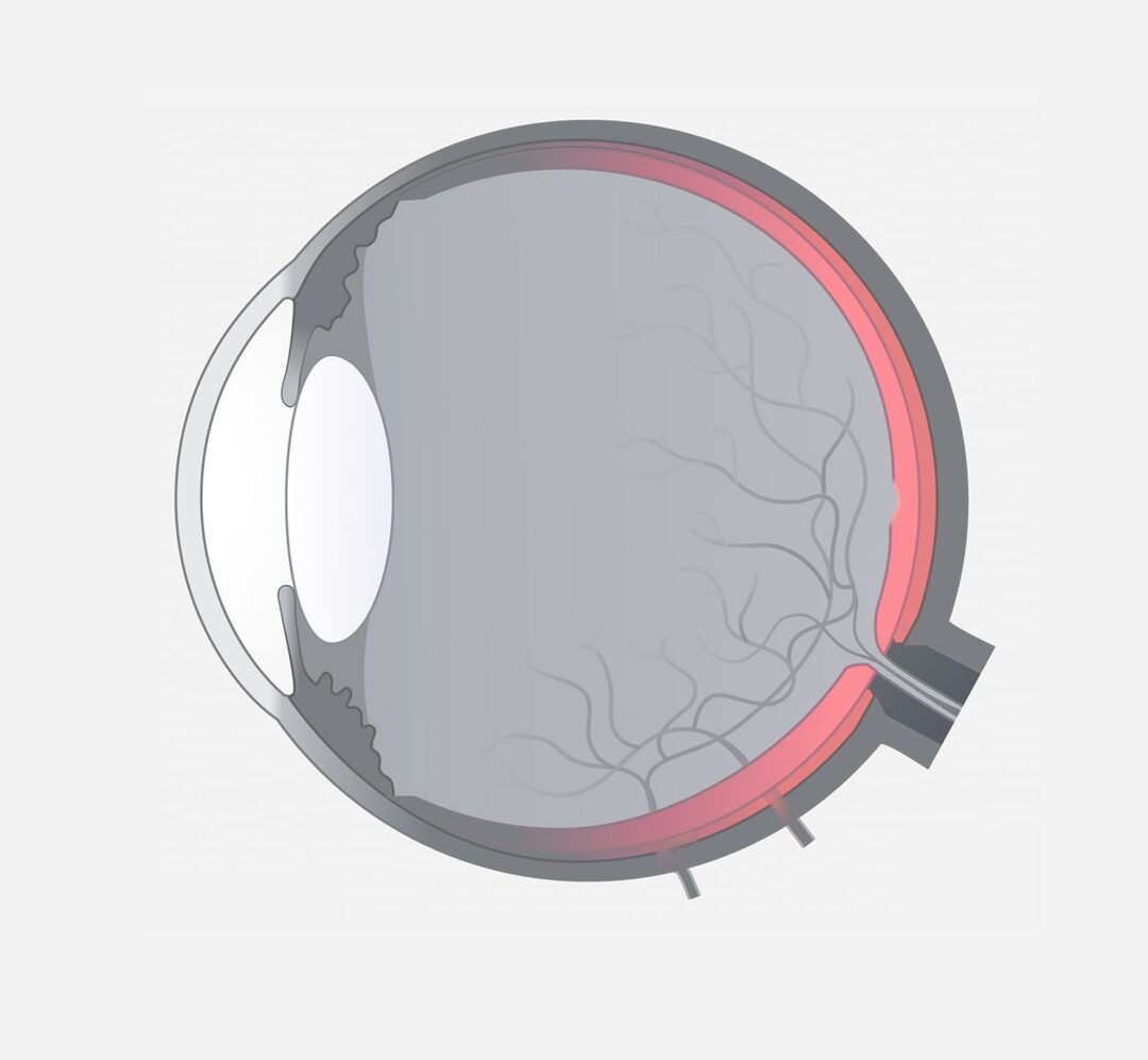 Uveitis posterior
